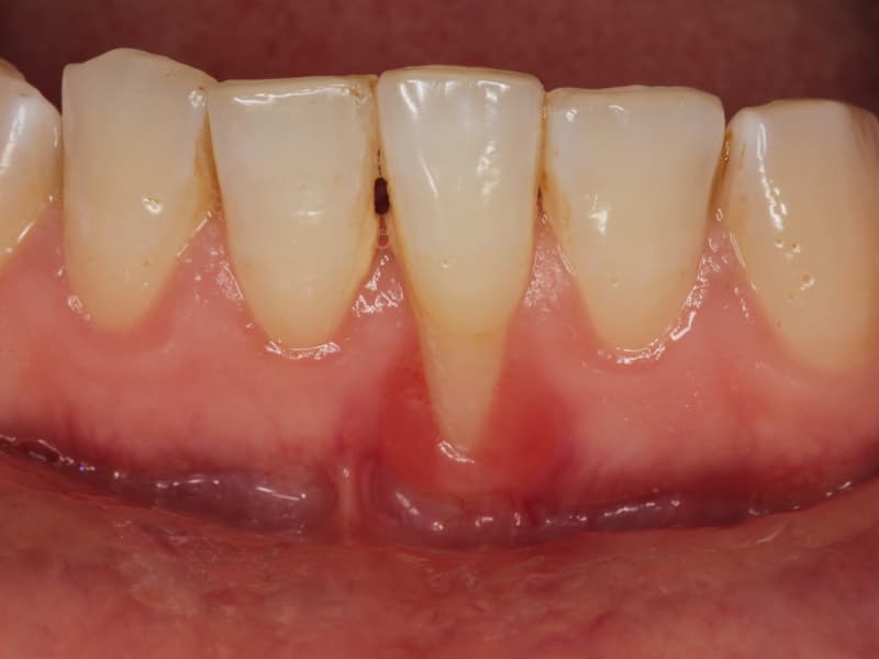 Tratamiento periodontal Ourense