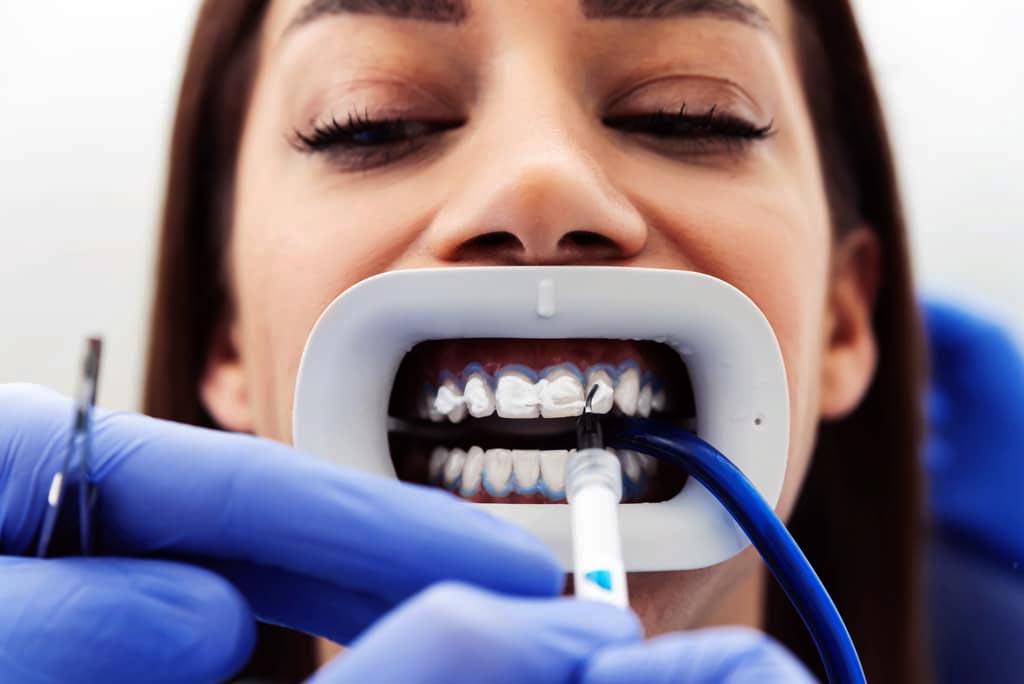 El blanqueamiento dental que devuelve la confianza a su sonrisa