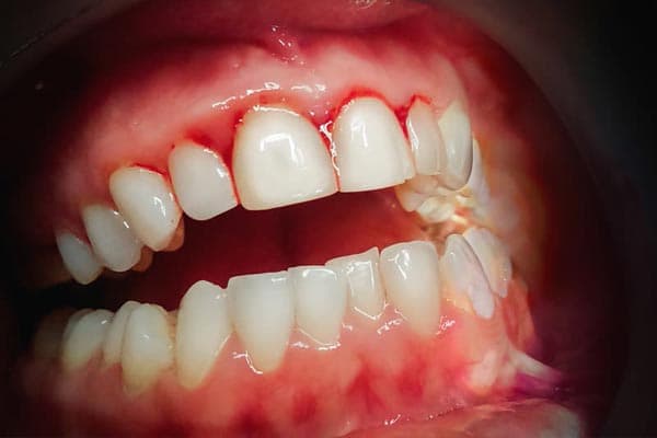 Gingivitis