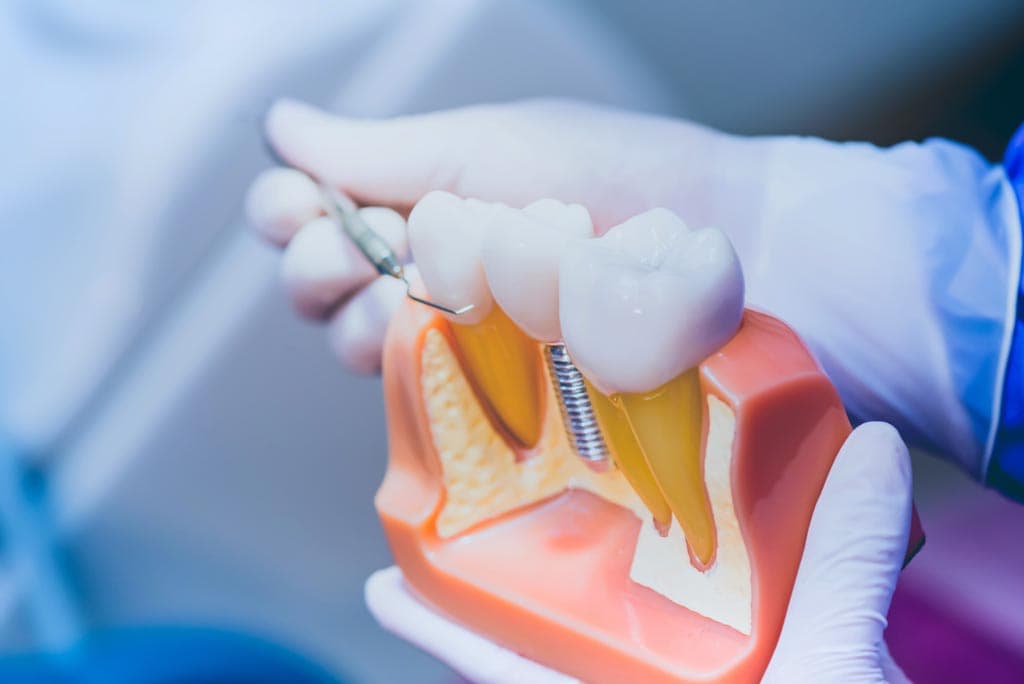 Implantología y cirugía oral en Ourense con diagnóstico previo y materiales de calidad