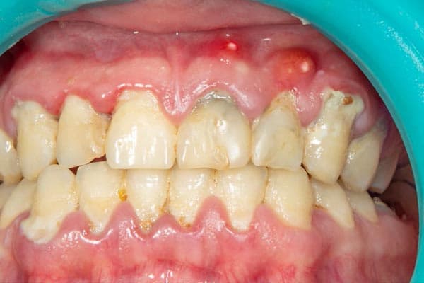 Periodontitis