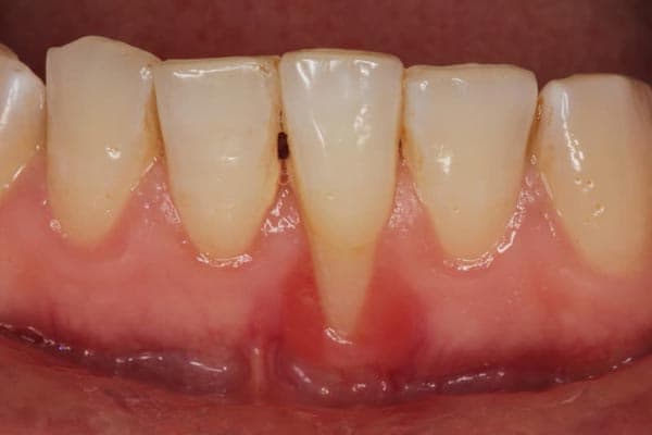 Recesión gingival