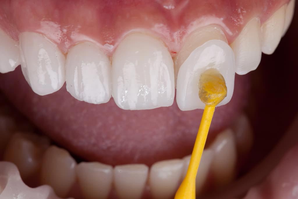 Vuelva a sonreír sin complejos gracias a nuestras coronas dentales en Ourense